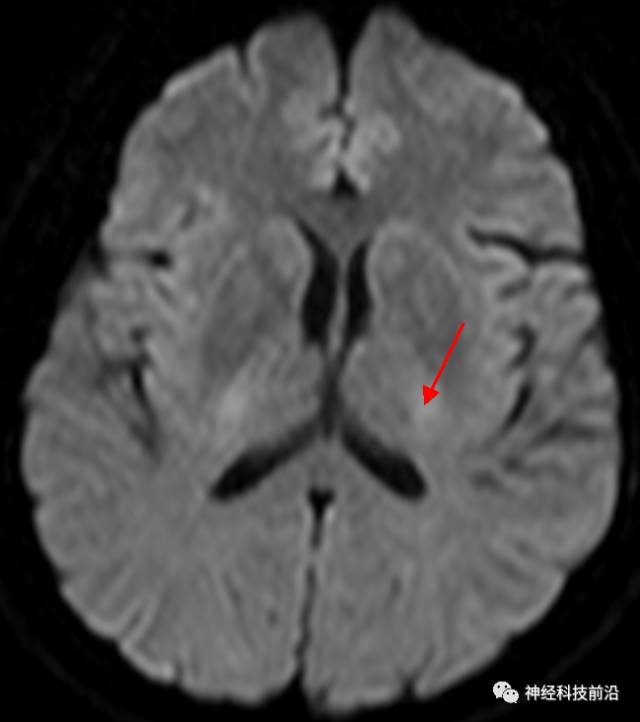 DWI序列脑干、内囊后肢高信号纤维束解析