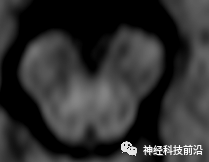 DWI序列脑干、内囊后肢高信号纤维束解析