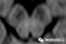 DWI序列脑干、内囊后肢高信号纤维束解析