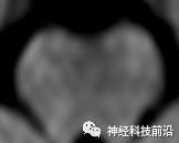 DWI序列脑干、内囊后肢高信号纤维束解析