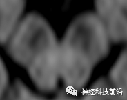 DWI序列脑干、内囊后肢高信号纤维束解析