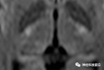 DWI序列脑干、内囊后肢高信号纤维束解析