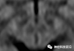 DWI序列脑干、内囊后肢高信号纤维束解析