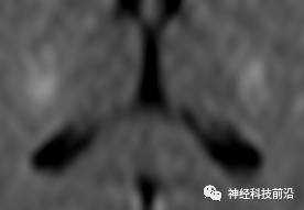 DWI序列脑干、内囊后肢高信号纤维束解析