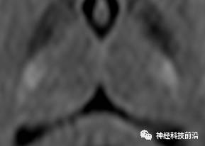 DWI序列脑干、内囊后肢高信号纤维束解析