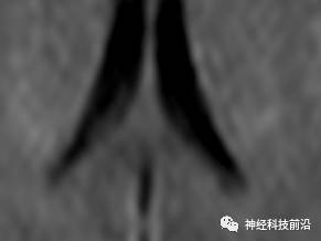 DWI序列脑干、内囊后肢高信号纤维束解析