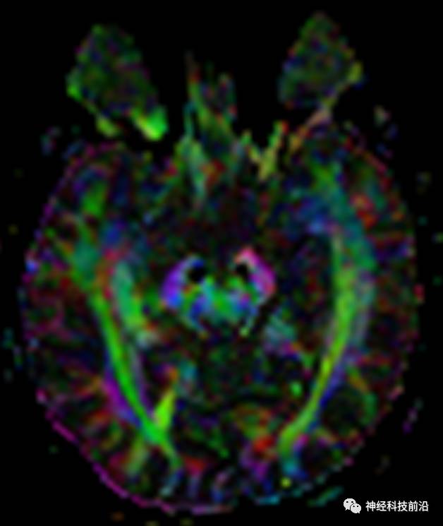 DWI序列脑干、内囊后肢高信号纤维束解析