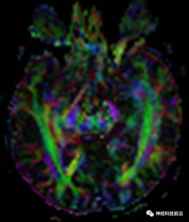 DWI序列脑干、内囊后肢高信号纤维束解析