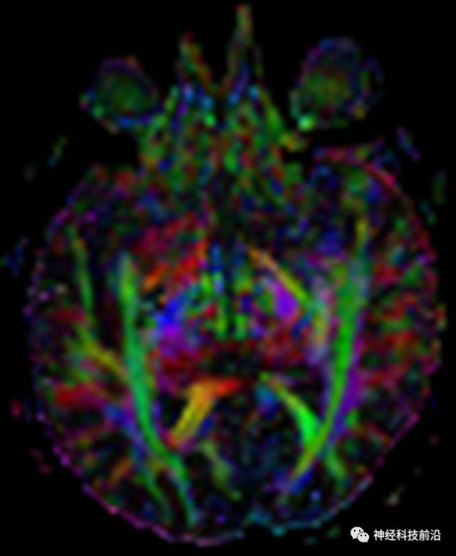 DWI序列脑干、内囊后肢高信号纤维束解析