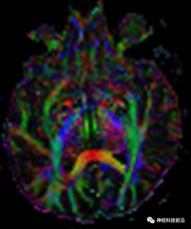 DWI序列脑干、内囊后肢高信号纤维束解析