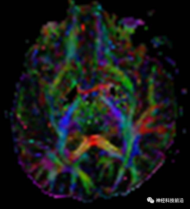DWI序列脑干、内囊后肢高信号纤维束解析