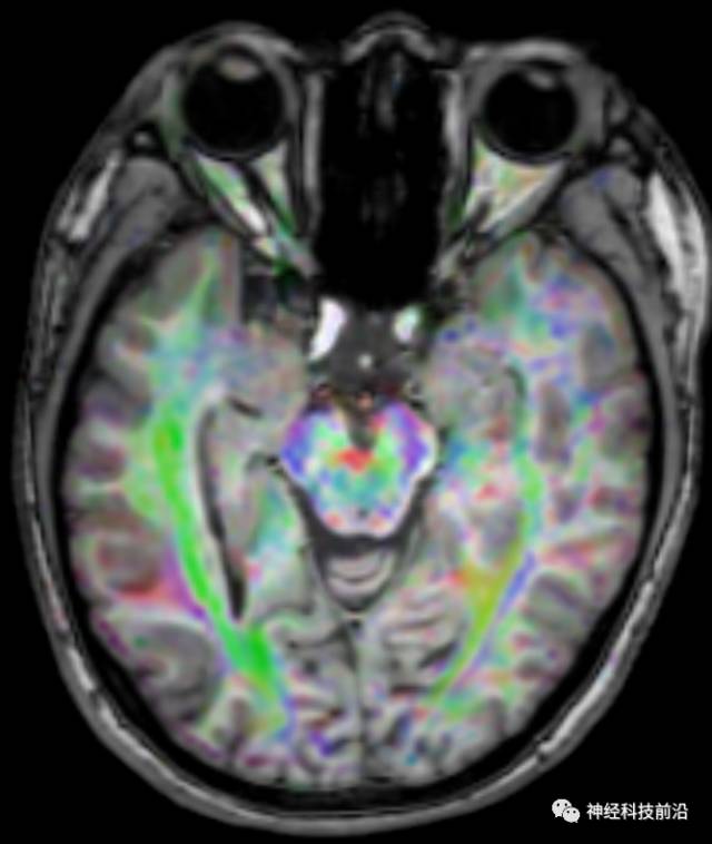 DWI序列脑干、内囊后肢高信号纤维束解析