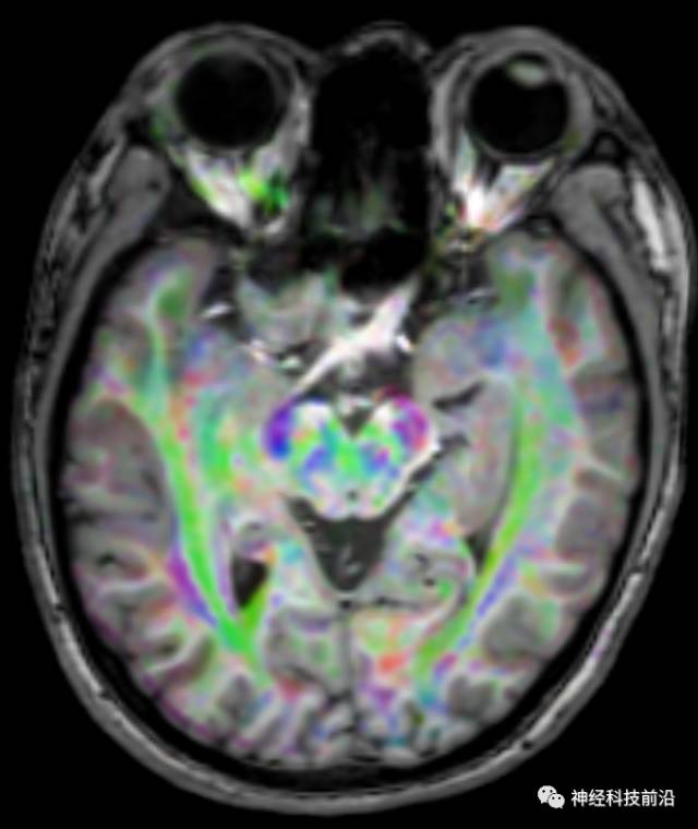 DWI序列脑干、内囊后肢高信号纤维束解析