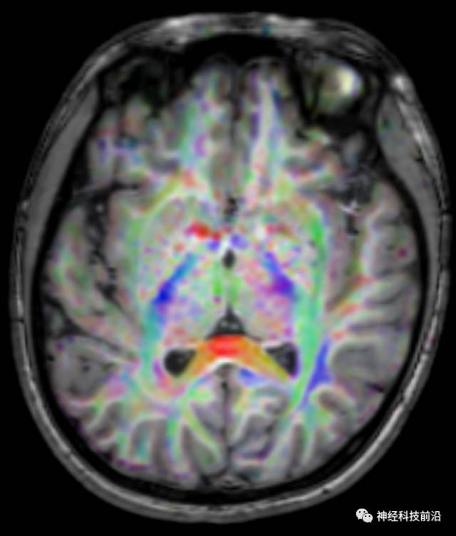 DWI序列脑干、内囊后肢高信号纤维束解析