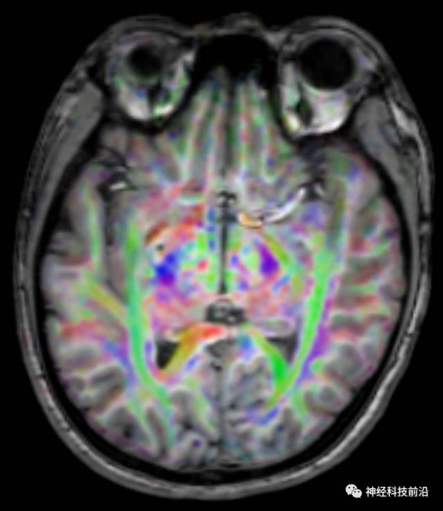 DWI序列脑干、内囊后肢高信号纤维束解析
