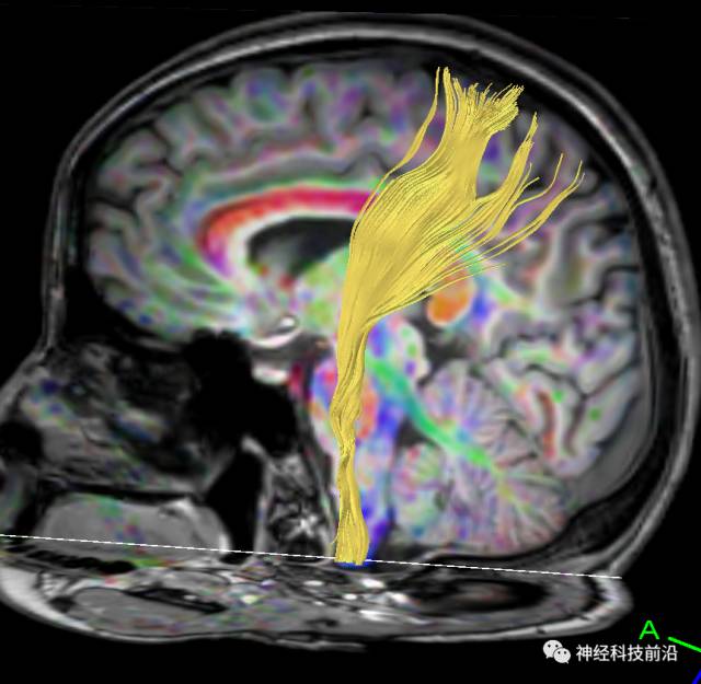 DWI序列脑干、内囊后肢高信号纤维束解析
