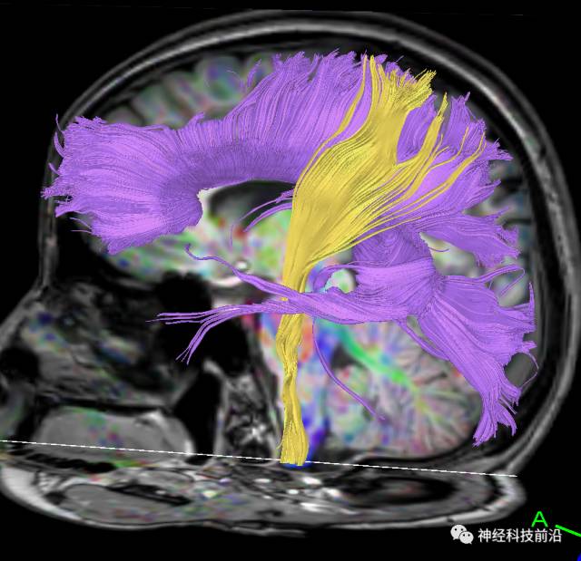 DWI序列脑干、内囊后肢高信号纤维束解析
