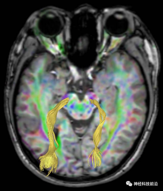 DWI序列脑干、内囊后肢高信号纤维束解析