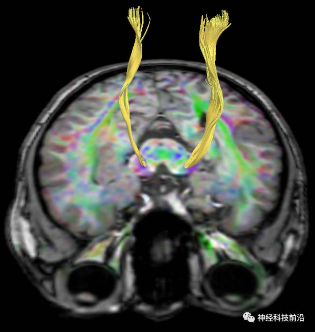 DWI序列脑干、内囊后肢高信号纤维束解析