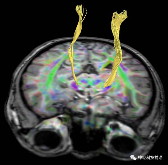 DWI序列脑干、内囊后肢高信号纤维束解析