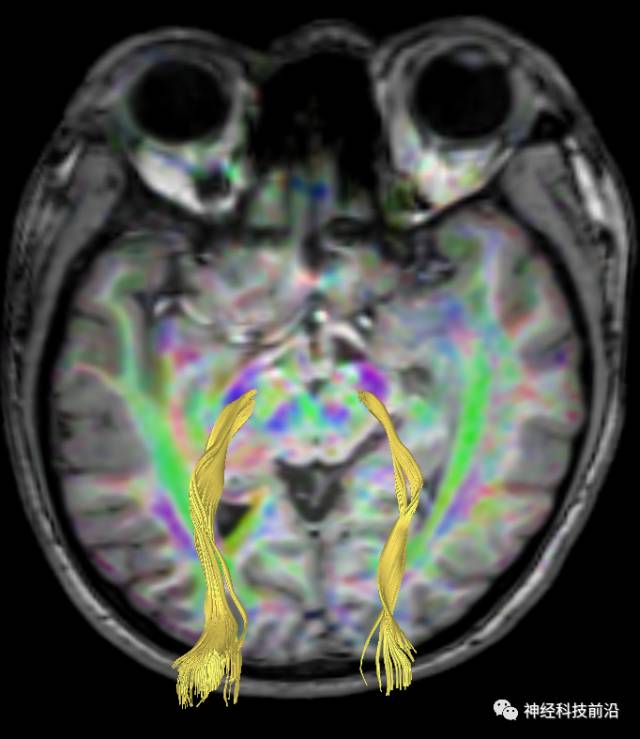 DWI序列脑干、内囊后肢高信号纤维束解析