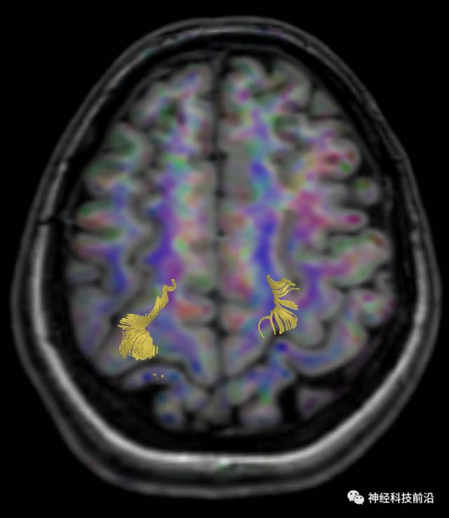 DWI序列脑干、内囊后肢高信号纤维束解析