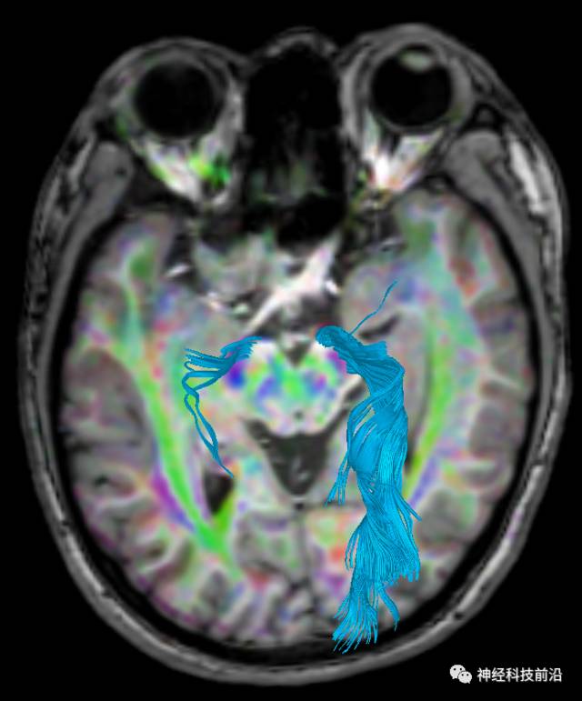 DWI序列脑干、内囊后肢高信号纤维束解析