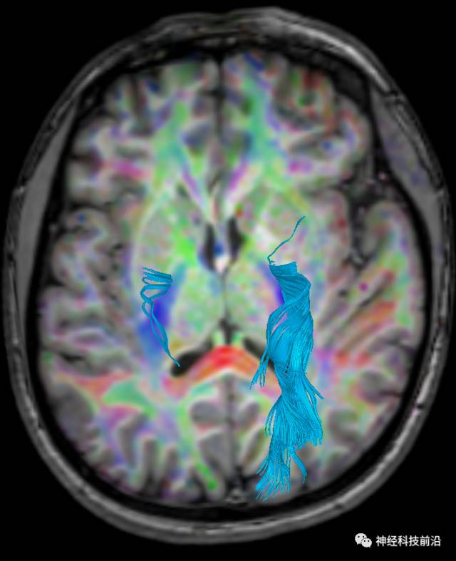 DWI序列脑干、内囊后肢高信号纤维束解析