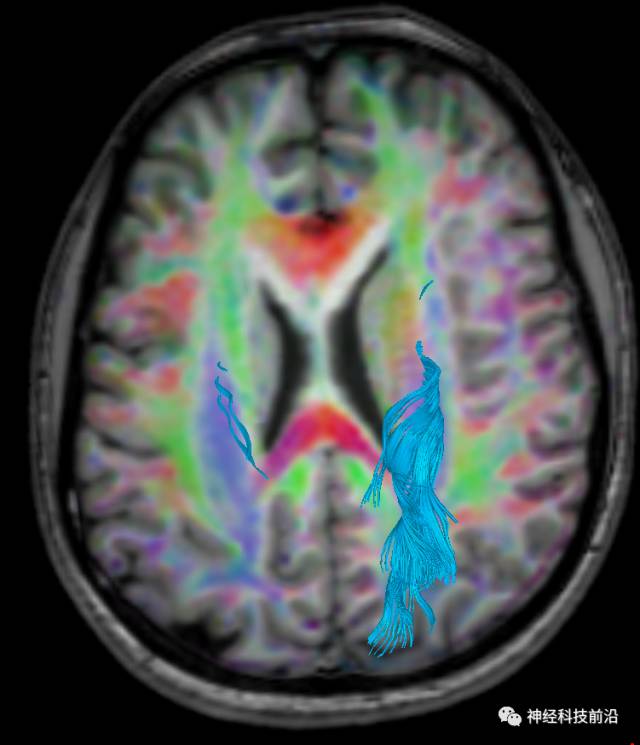 DWI序列脑干、内囊后肢高信号纤维束解析