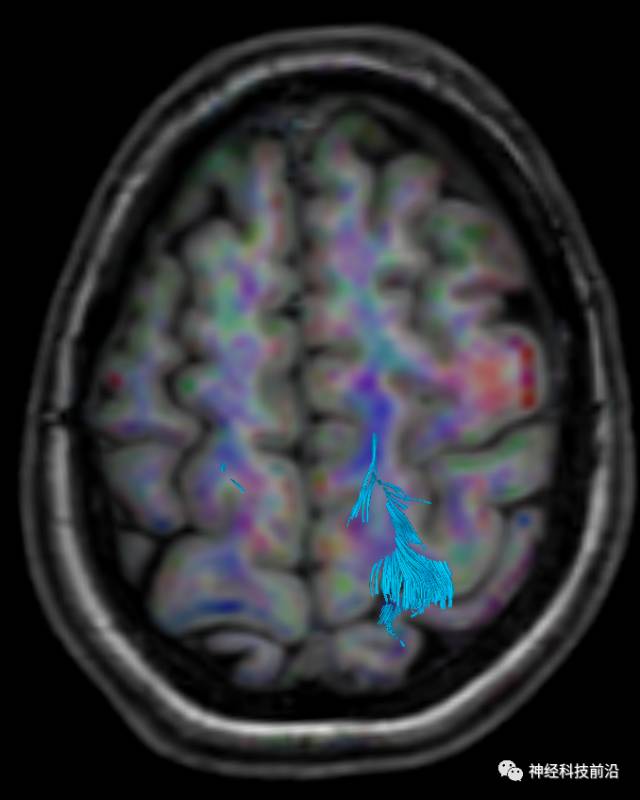 DWI序列脑干、内囊后肢高信号纤维束解析