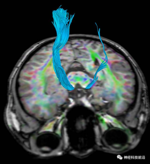 DWI序列脑干、内囊后肢高信号纤维束解析