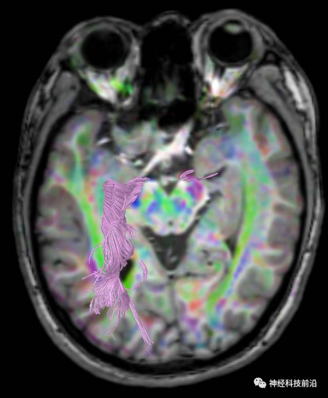 DWI序列脑干、内囊后肢高信号纤维束解析