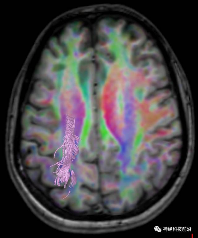 DWI序列脑干、内囊后肢高信号纤维束解析