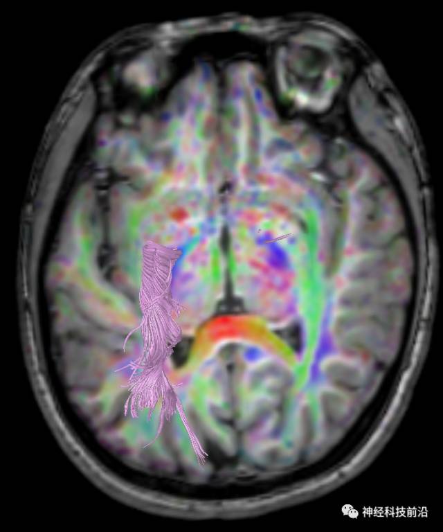 DWI序列脑干、内囊后肢高信号纤维束解析