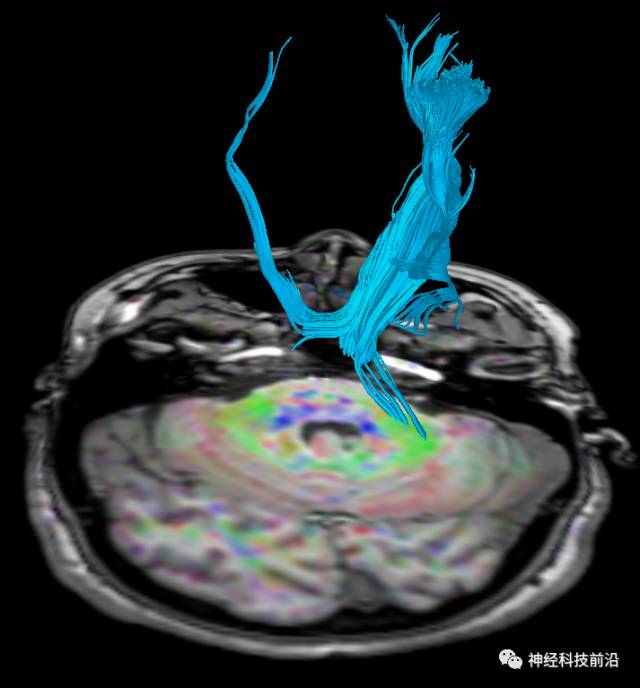 DWI序列脑干、内囊后肢高信号纤维束解析
