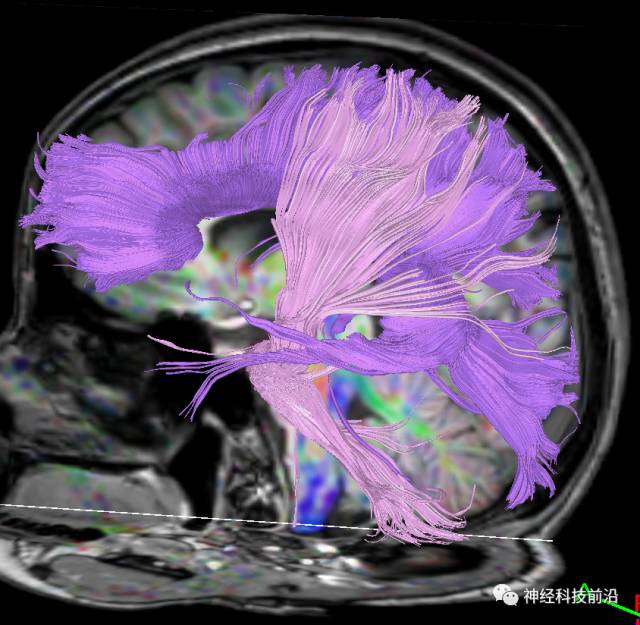 DWI序列脑干、内囊后肢高信号纤维束解析