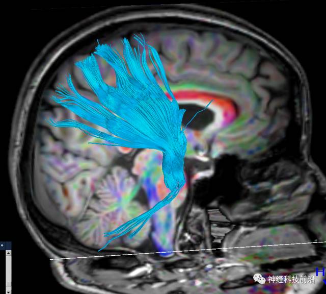 DWI序列脑干、内囊后肢高信号纤维束解析