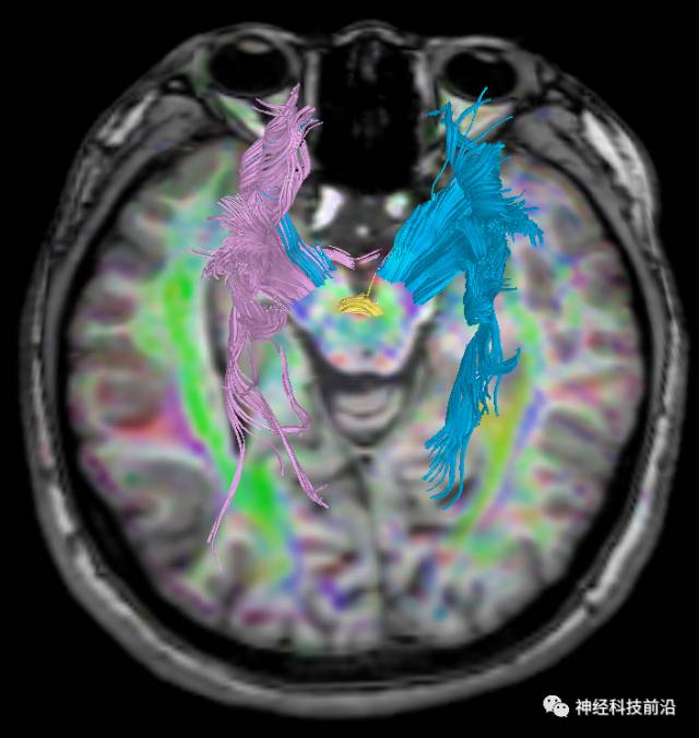 DWI序列脑干、内囊后肢高信号纤维束解析