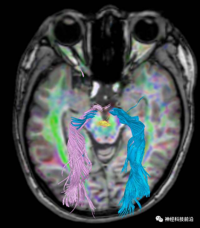 DWI序列脑干、内囊后肢高信号纤维束解析
