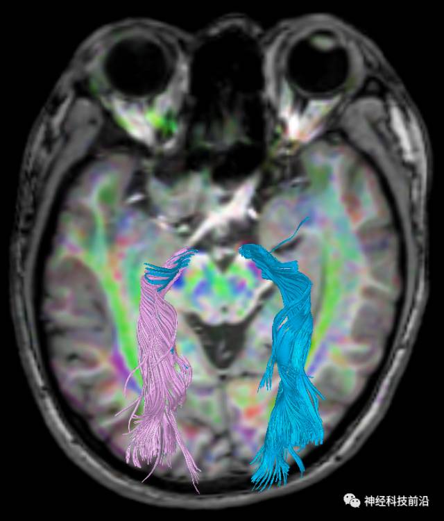 DWI序列脑干、内囊后肢高信号纤维束解析