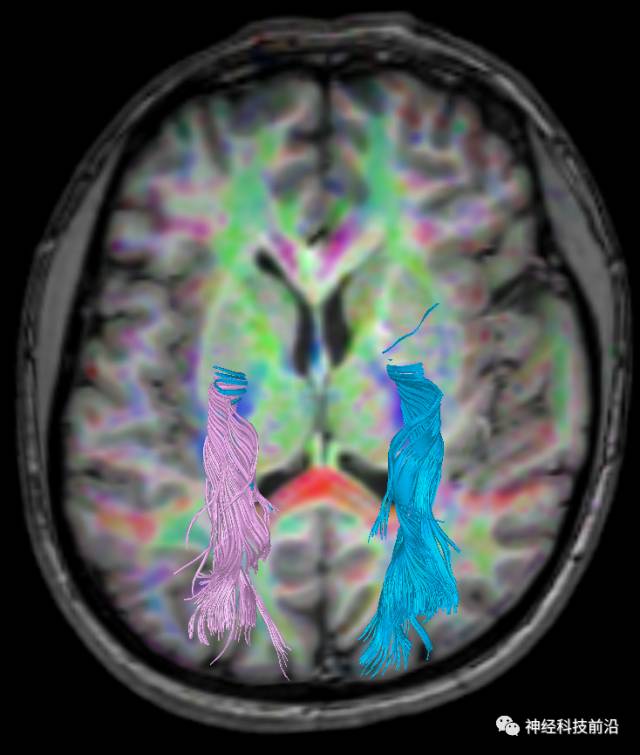 DWI序列脑干、内囊后肢高信号纤维束解析