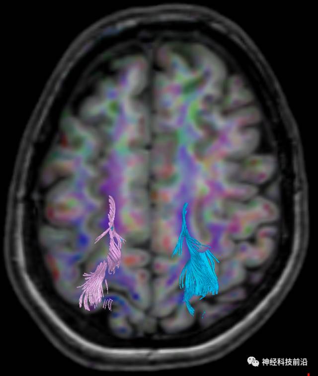 DWI序列脑干、内囊后肢高信号纤维束解析