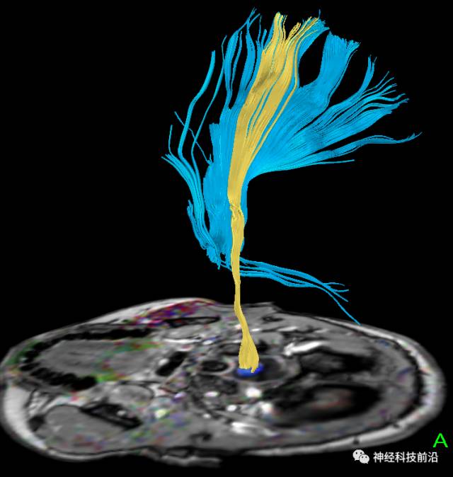 DWI序列脑干、内囊后肢高信号纤维束解析
