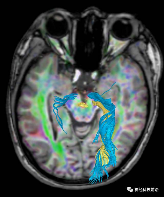 DWI序列脑干、内囊后肢高信号纤维束解析