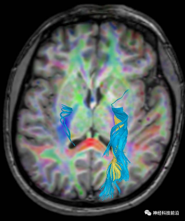 DWI序列脑干、内囊后肢高信号纤维束解析