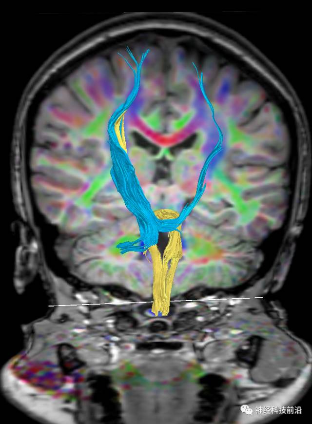 DWI序列脑干、内囊后肢高信号纤维束解析