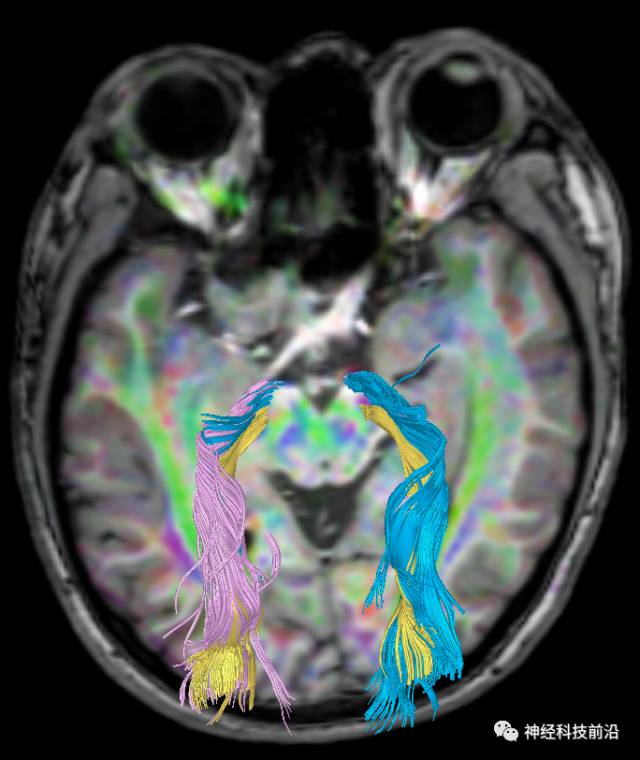 DWI序列脑干、内囊后肢高信号纤维束解析