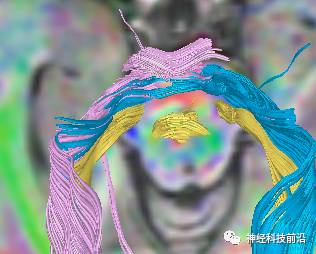 DWI序列脑干、内囊后肢高信号纤维束解析