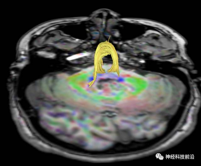 DWI序列脑干、内囊后肢高信号纤维束解析