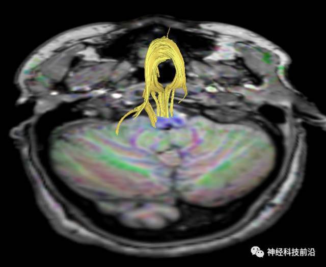 DWI序列脑干、内囊后肢高信号纤维束解析